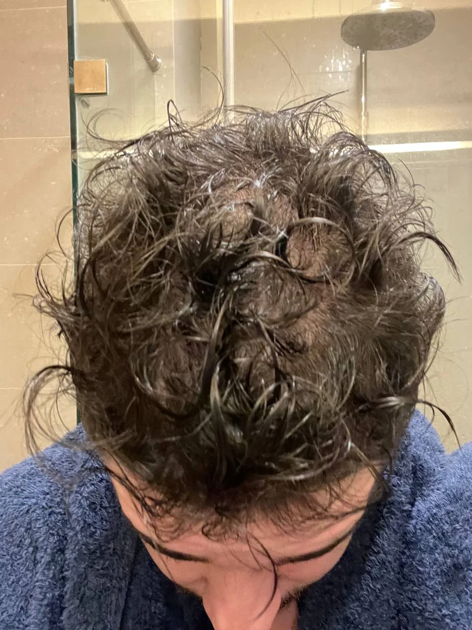 KLOW hair before thinning